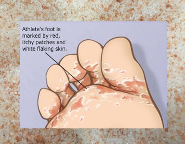 Himalayan Pink Salt for Athlete’s Foot and Warts